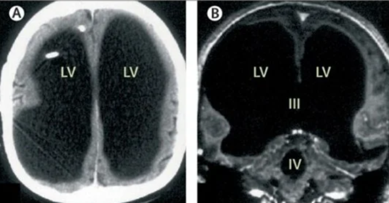 ПАРАДОКС: Безмозъчен французин е абсолютна загадка за медицината