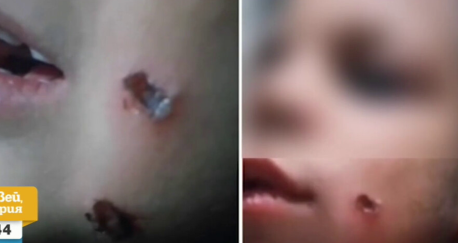 Подозират майка, че е горила лицето на детето си с цигара (КАДРИ)