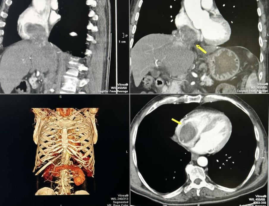 Лекари спасиха пациент с огромен тумор в черния дроб и сърцето