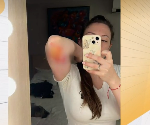 Млада жена разказа как е нападната от куче от бойна порода