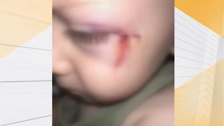 2-годишно дете е с шевове на лицето след инцидент в детски център