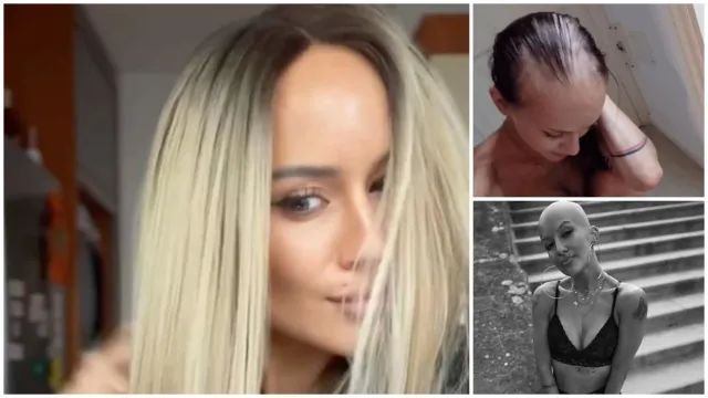 Жена оплешивява напълно, след като си уголемява бюста (СНИМКИ)