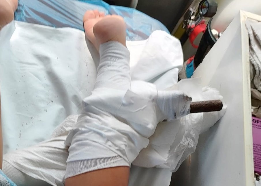 ШОК: Дръжка от чадър се заби в крака на млада жена на плаж в Гърция