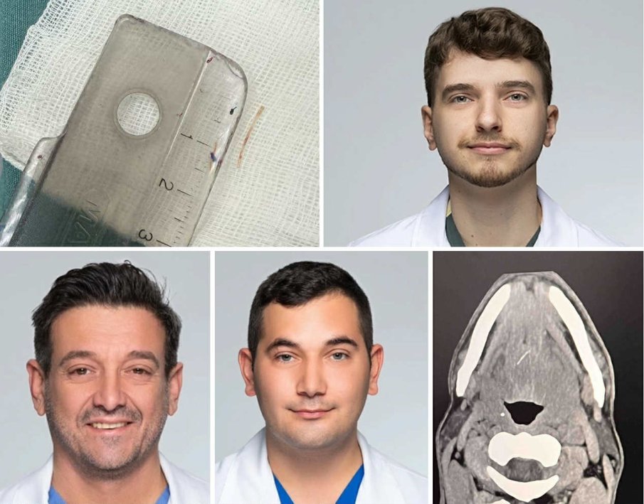 Лекари спасиха мъж с рядко и опасно усложнение от рибена кост в Пловдив