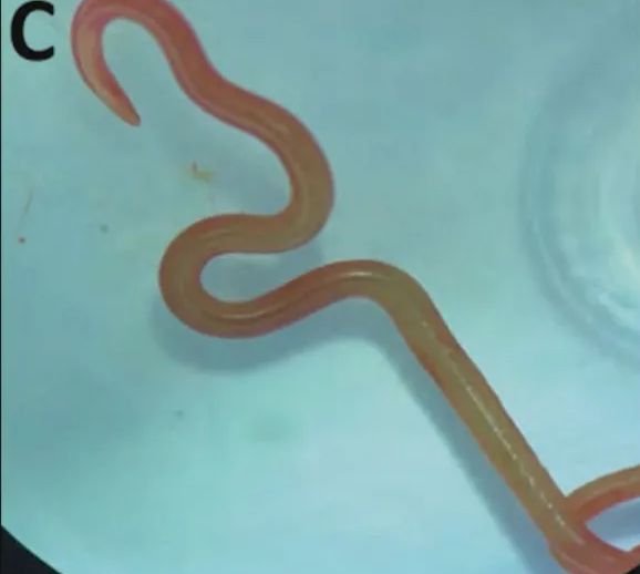Първи случай на човек, заразен с паразитен червей в САЩ