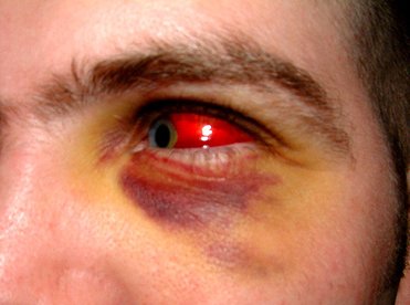 Разследват жена, бръкнала в окото на приятеля си при скандал