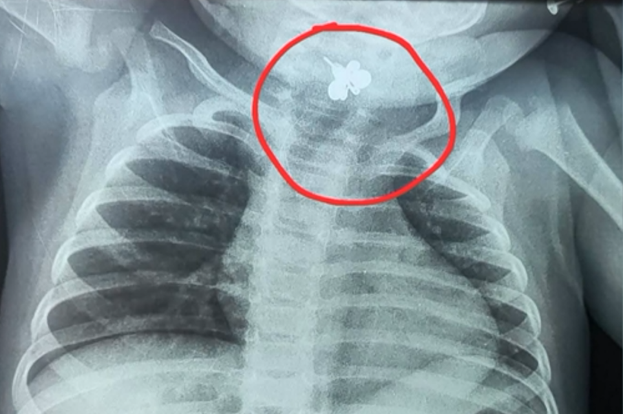 Оперираха 10-месечно бебе, погълнало обеца