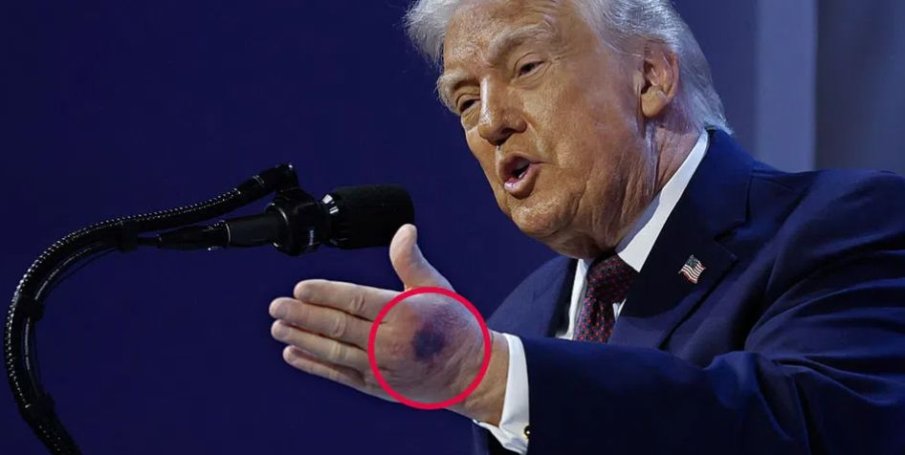 Тръмп обясни на какво се дължи синината на ръката му