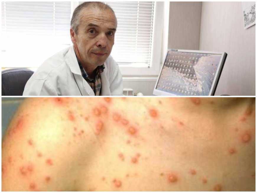 ВНИМАНИЕ. РОДИТЕЛИ: Доц. Мангъров бие аларма за възможна епидемия от морбили