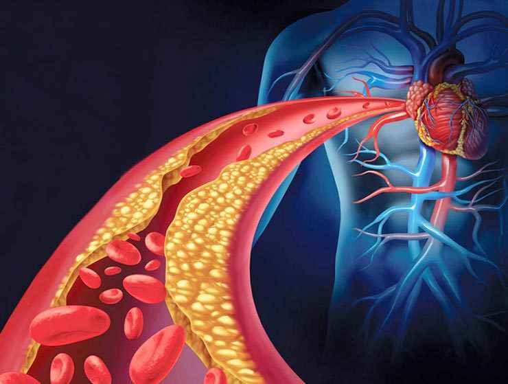 Само хората с наднормено тегло ли са изложени на риск от висок холестерол