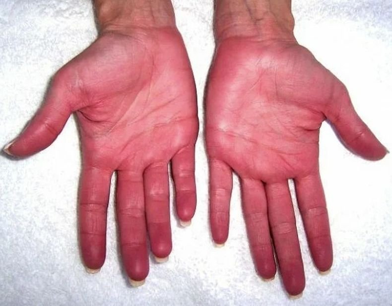 Червените длани могат да бъдат признак за опасно заболяване