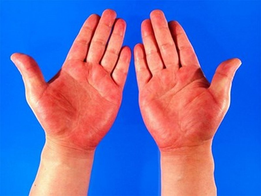 ВНИМАВАЙТЕ! Червените длани могат да бъдат признак за опасно заболяване