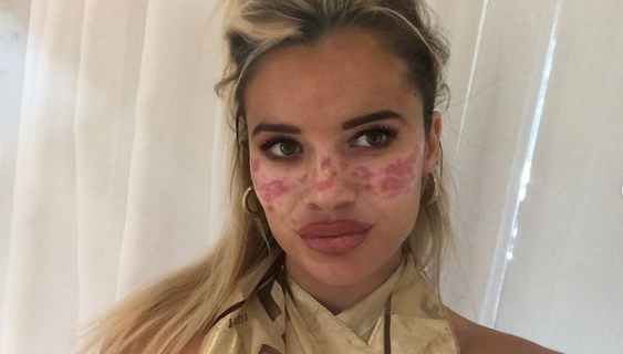 Инфлуенсърка съсипа кожата си, пресъздавайки TikTok тренд за лунички