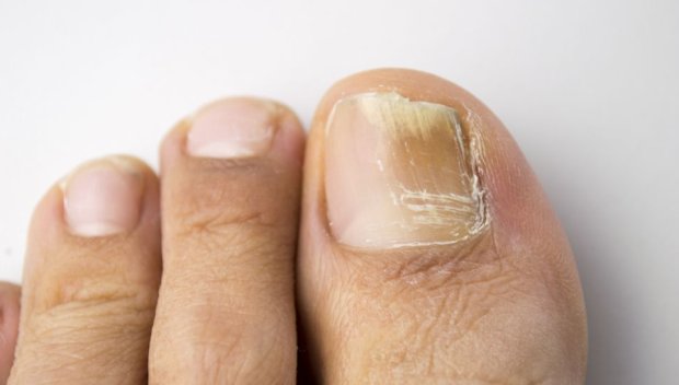 Пет проблема с ноктите на краката и как да се погрижите за тях