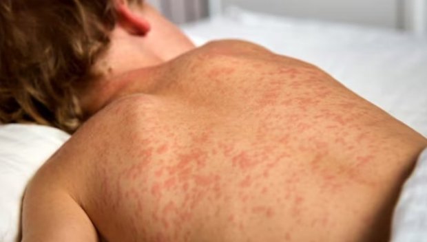 43 случая на морбили са регистрирани у нас