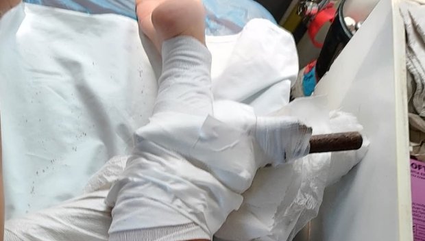 ШОК: Дръжка от чадър се заби в крака на млада жена на плаж в Гърция