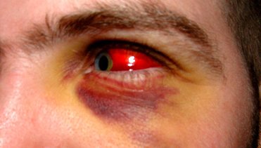 Разследват жена, бръкнала в окото на приятеля си при скандал