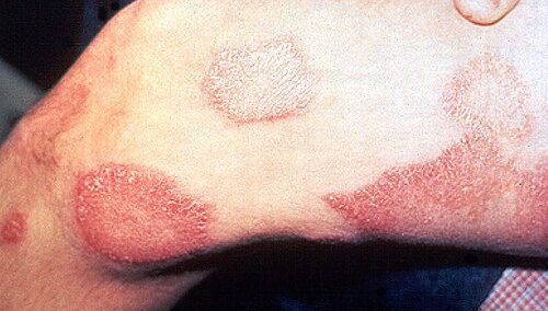 В Хърватия потвърдиха случай на проказа