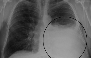 прегледи усложнения covid правят бургас