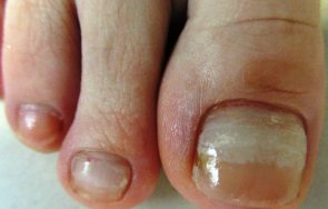 справите врасналите нокти краката