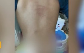 съмнения насилие детска ясла родители прибрали детето синини наранявания гърба