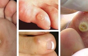 домашни средства кокоши трън