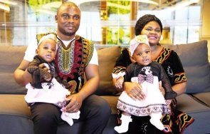 Сиамски близнаци от Камерун възвърнаха здравето си след успешна 27 часова