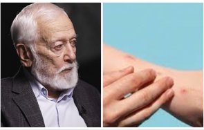 вирусолог маймунската шарка зарази милиони