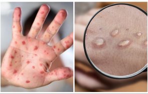 случва първи случаи маймунска шарка деца