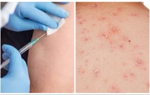 без конспирации ваксините covid причиняват маймунска шарка