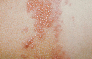 появява какви симптомите херпес зостер