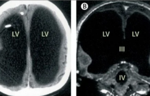 безмозъчен французин загадка медицината