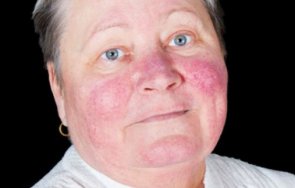 знаете болест нарича вълчанка