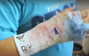 седмокласник счупена ръка спречкване училище