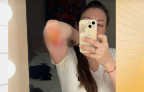 млада жена разказа нападната куче бойна порода