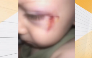 годишно дете шевове лицето инцидент детски център