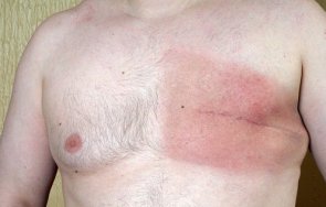 мъжете рак гърдата получават вече безплатна хормонална терапия 