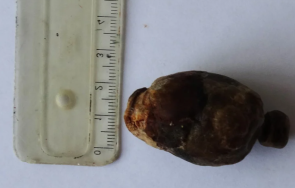 камък яйце извадиха пациентка пловдив