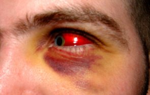 разследват жена бръкнала окото приятеля скандал