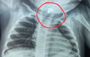 оперираха месечно бебе погълнало обеца