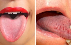 зачервяването езика говори тежки болести