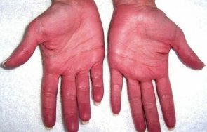 червените длани бъдат признак опасно заболяване
