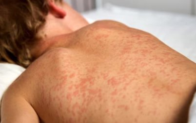 почина второ дете заразено морбили сащ