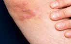 Кожните заболявания се влошават след прекаран COVID-19