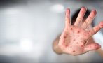 Епидемия от морбили върлува в Босна и Херцеговина